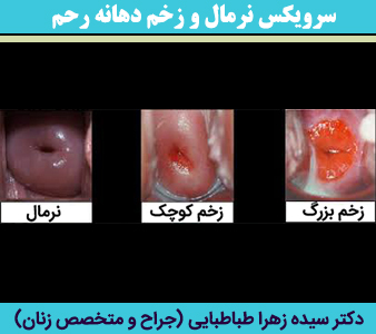 سرویکس-نرمال-و-زخم-دهانه-رحم