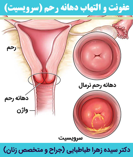 عفونت-و-التهاب-دهانه-رحم-(سرویسیت)