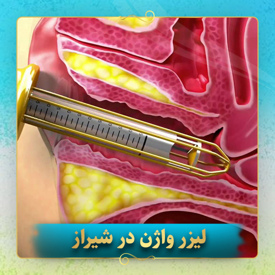 لیزر-واژن-در-شیراز