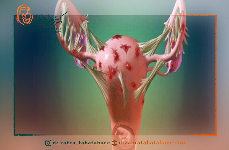 انواع اندومتریوز