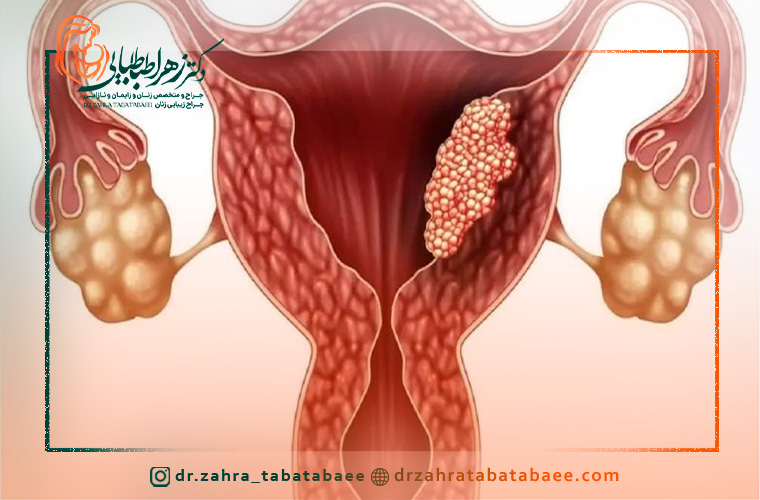 مراحل اندومتریوز