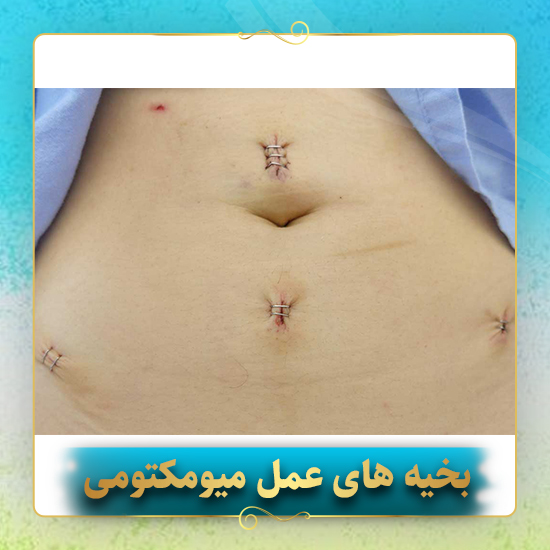 بخیه-های-عمل-میومکتومی