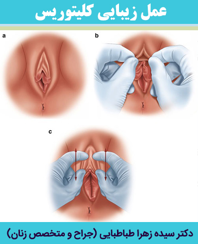 عمل-زیبایی-کلیتوریس