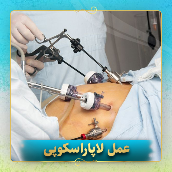 عمل-لاپاراسکوپی