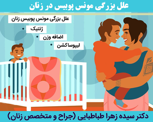 علل-بزرگی-مونس-پوبیس-در-زنان