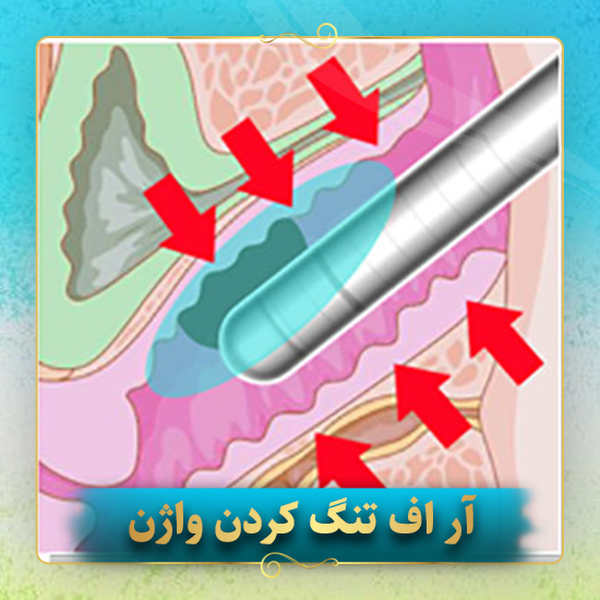 آر-اف-تنگ-کردن-واژن