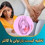تخلیه-کیست-بارتولن-با-کاتتر