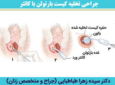 جراحی-تخلیه-کیست-بارتولن-با-کاتتر