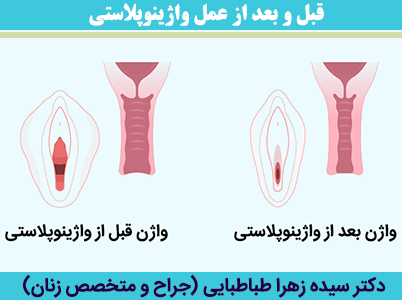 قبل-و-بعد-از-عمل-واژینوپلاستی