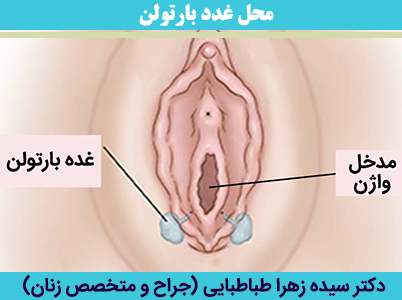 محل-غدد-بارتولن