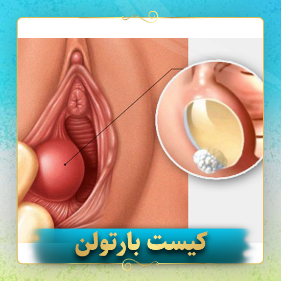 کیست-بارتولن