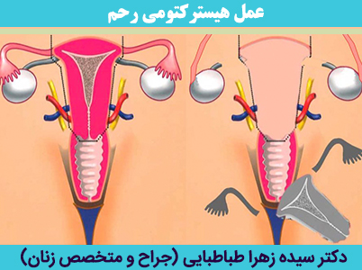 عمل-هیسترکتومی-رحم