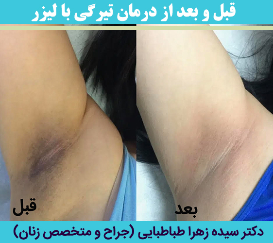 قبل-و-بعد-از-درمان-تیرگی-با-لیزر