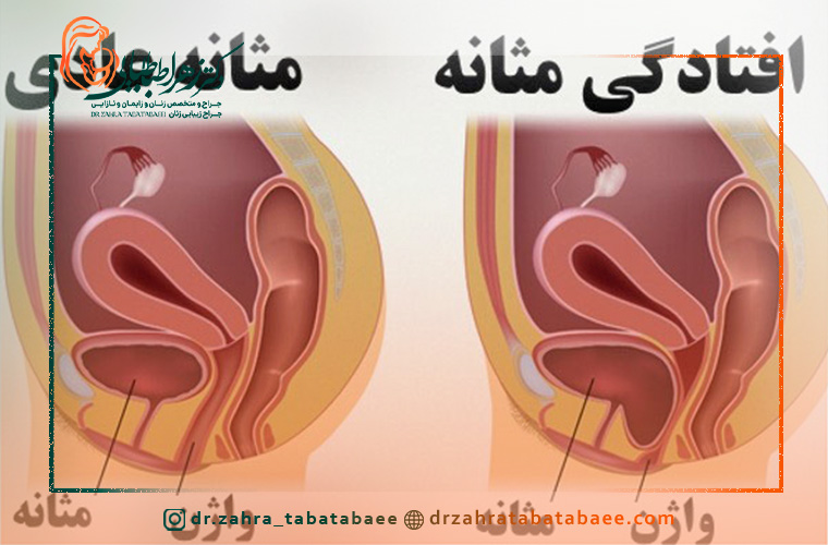 عوارض بعد از عمل افتادگی مثانه