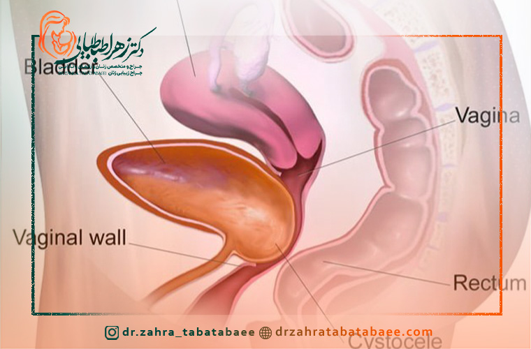 سوالات درباره افتادگی یا سیتوسل مثانه