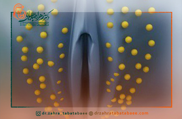 ماندگاری پروتز لابیاماژور با چربی چقدر طول می کشد؟