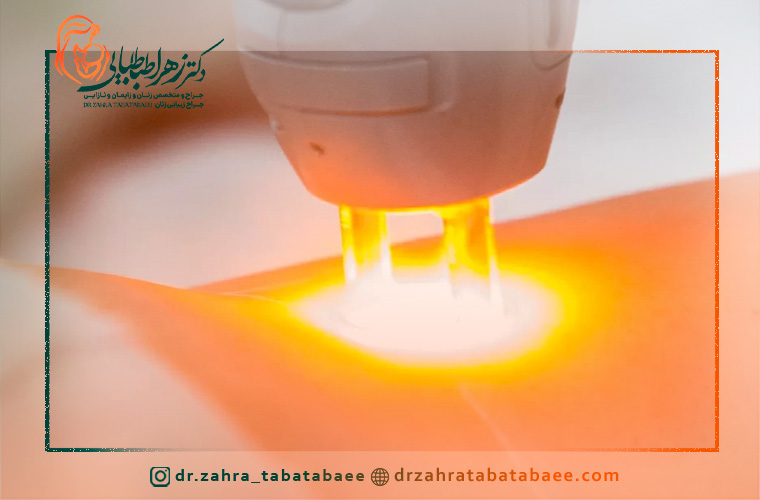 میزان ماندگاری لیزر واژن