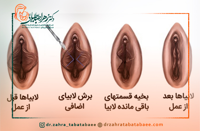 درمان هیپرتروفی لابیا در شیراز