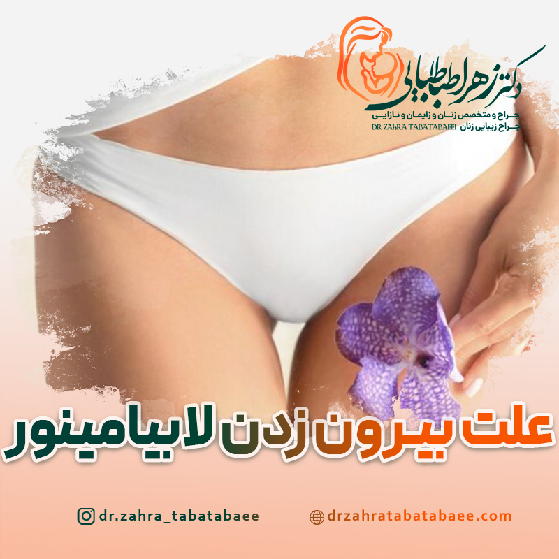 علت بیرون زدن لابیامینور