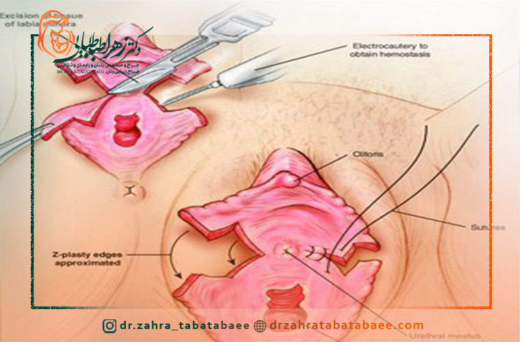 بخیه بعد از لابیاپلاستی
