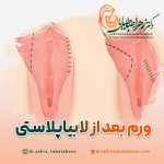 درمان ورم بعد از عمل زیبایی لابیاپلاستی