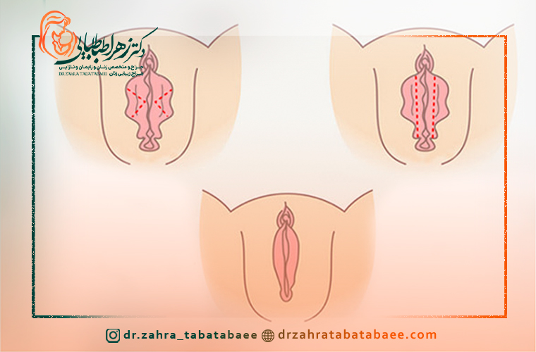 تغذیه و کاهش ورم بعد از لابیاپلاستی