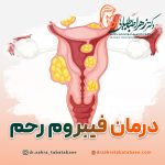 درمان قطعی فیبروم رحمی در شیراز
