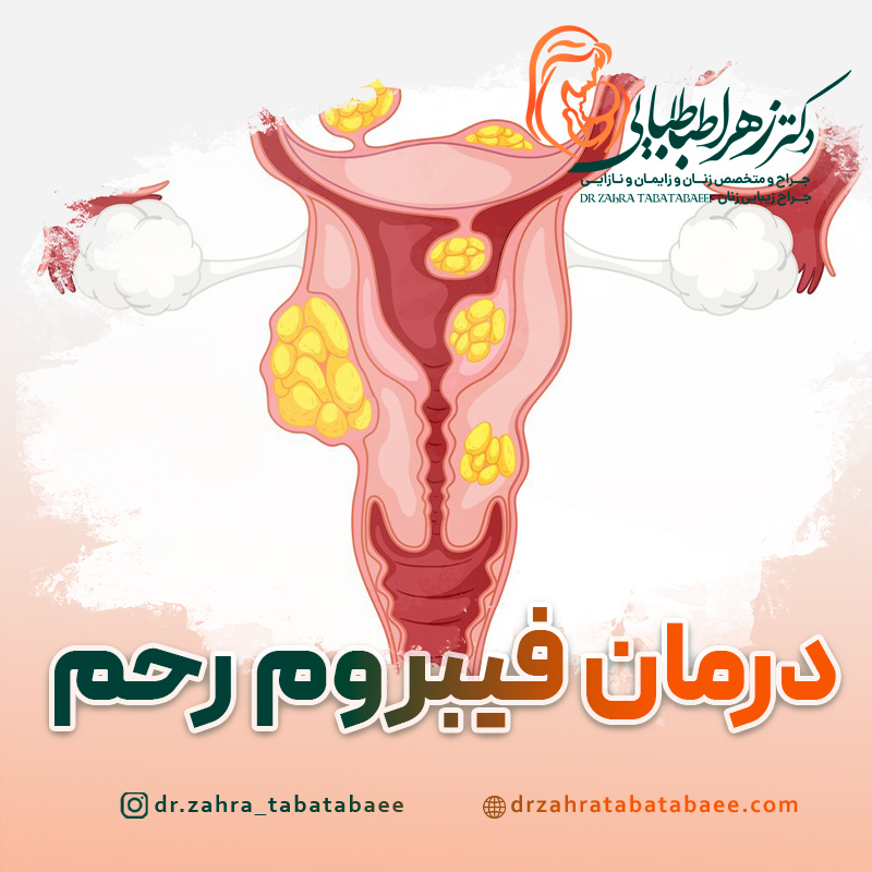 درمان قطعی فیبروم رحمی در شیراز