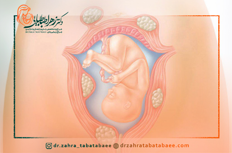 فیبروم رحم و بارداری