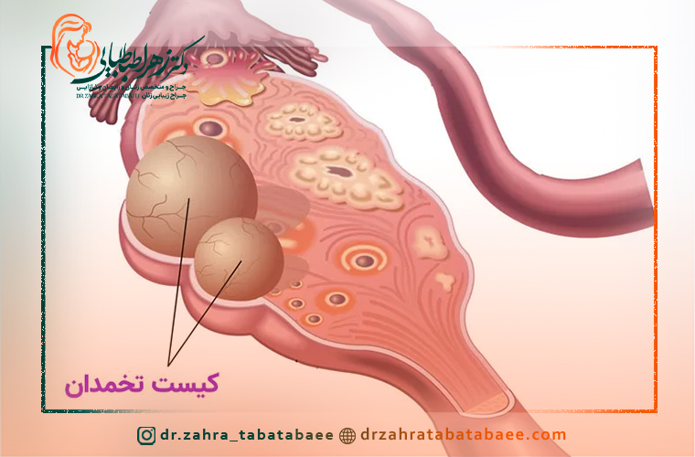 آیا کیست تخمدان خطرناک است؟