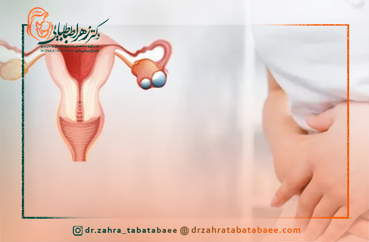 چه زمانی باید برای درمان کیست تخمدان اقدام کرد؟