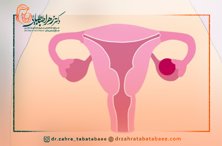 علت بروز کیست تخمدان