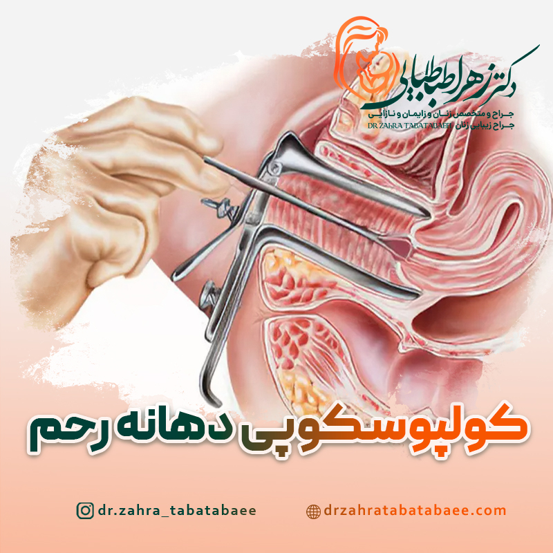 کولپوسکوپی دهانه رحم