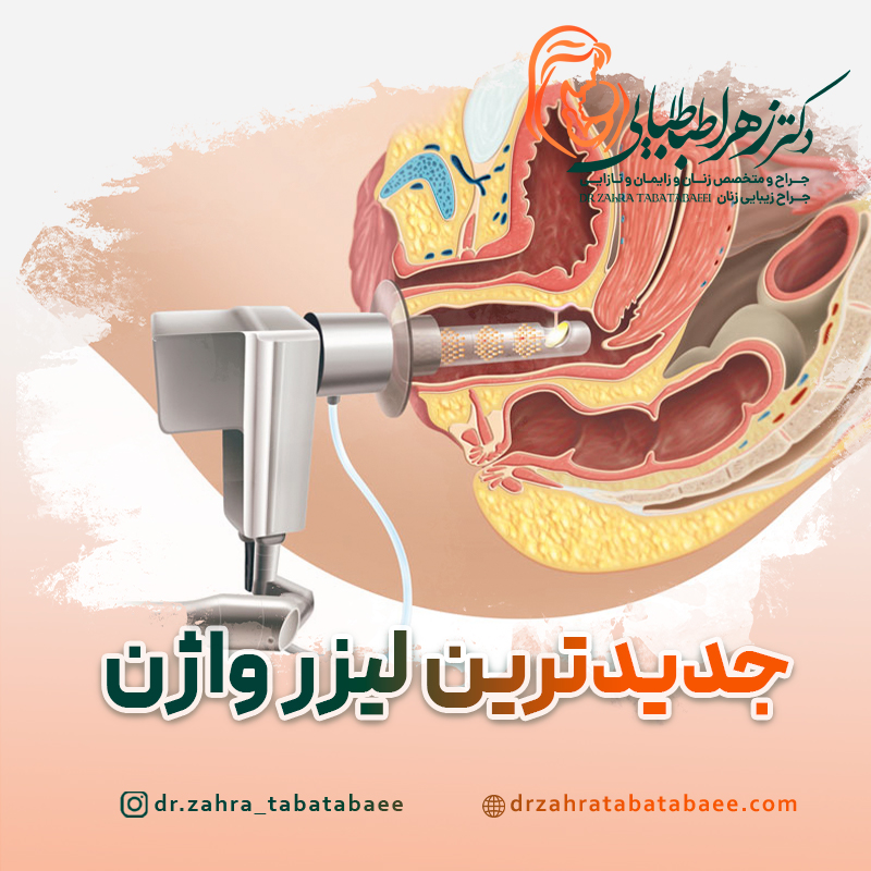 جدیدترین لیزر واژن در شیراز + هزینه لیزر واژینال