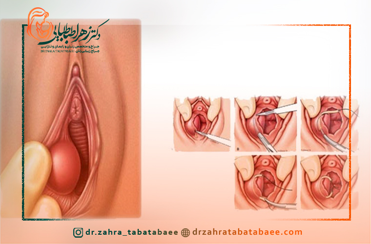 علائم کیست غدد بارتولن