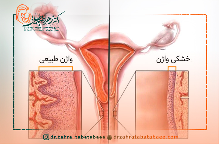 خشکی و آتروفی واژن چیست؟