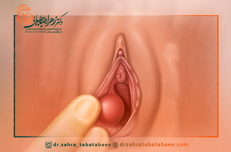 جراحی غده بارتولن در شیراز