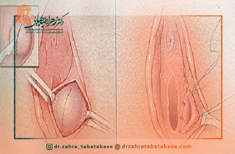هزینه عمل کیست بارتولن در شیراز