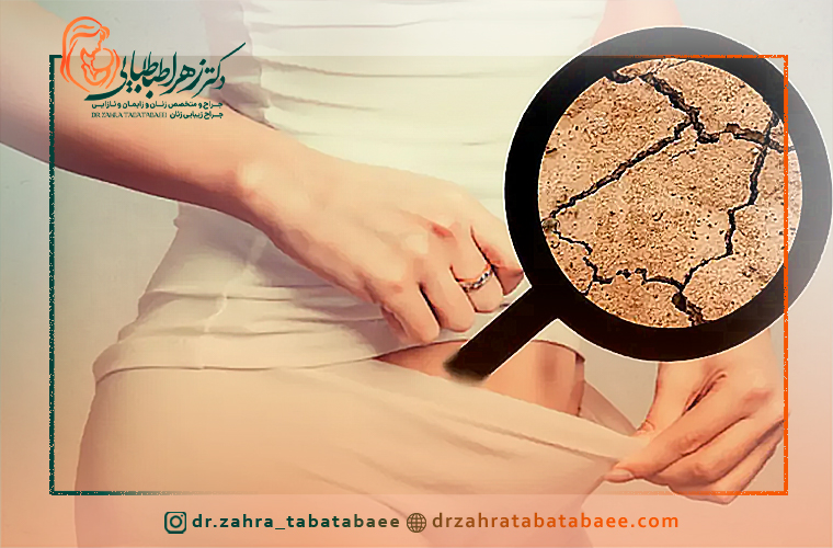 راههای درمان خشکی و آتروفی واژن