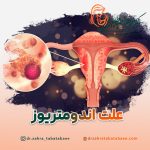 علت ایجاد اندومتریوز