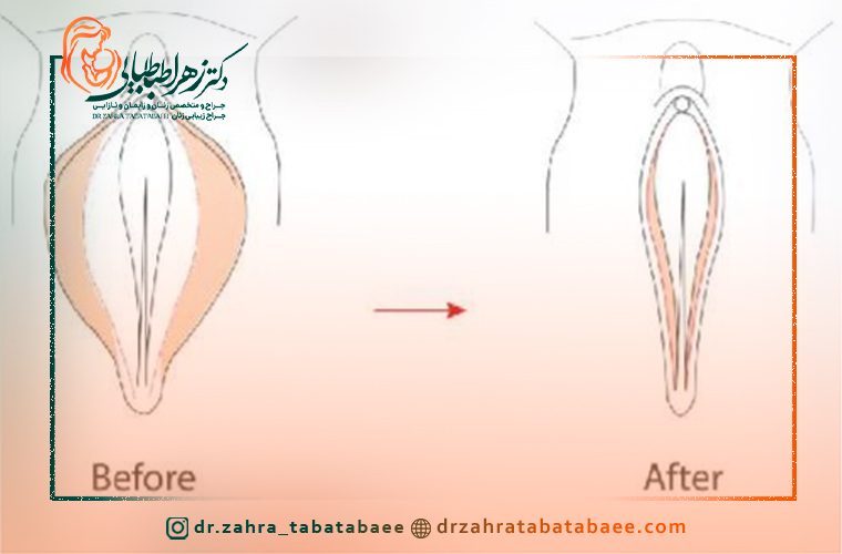 شرایط لازم برای لابیاپلاستی